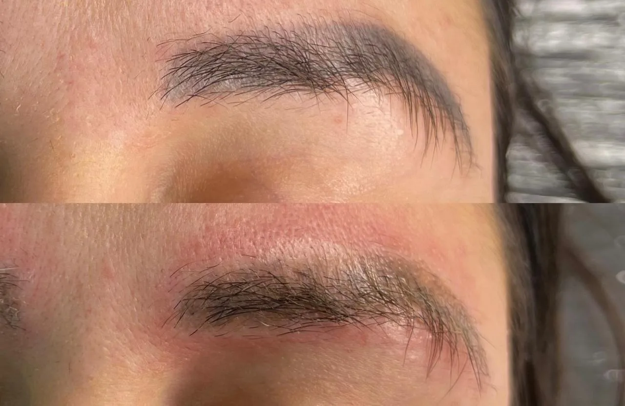 Antes e depois de remoção a laser