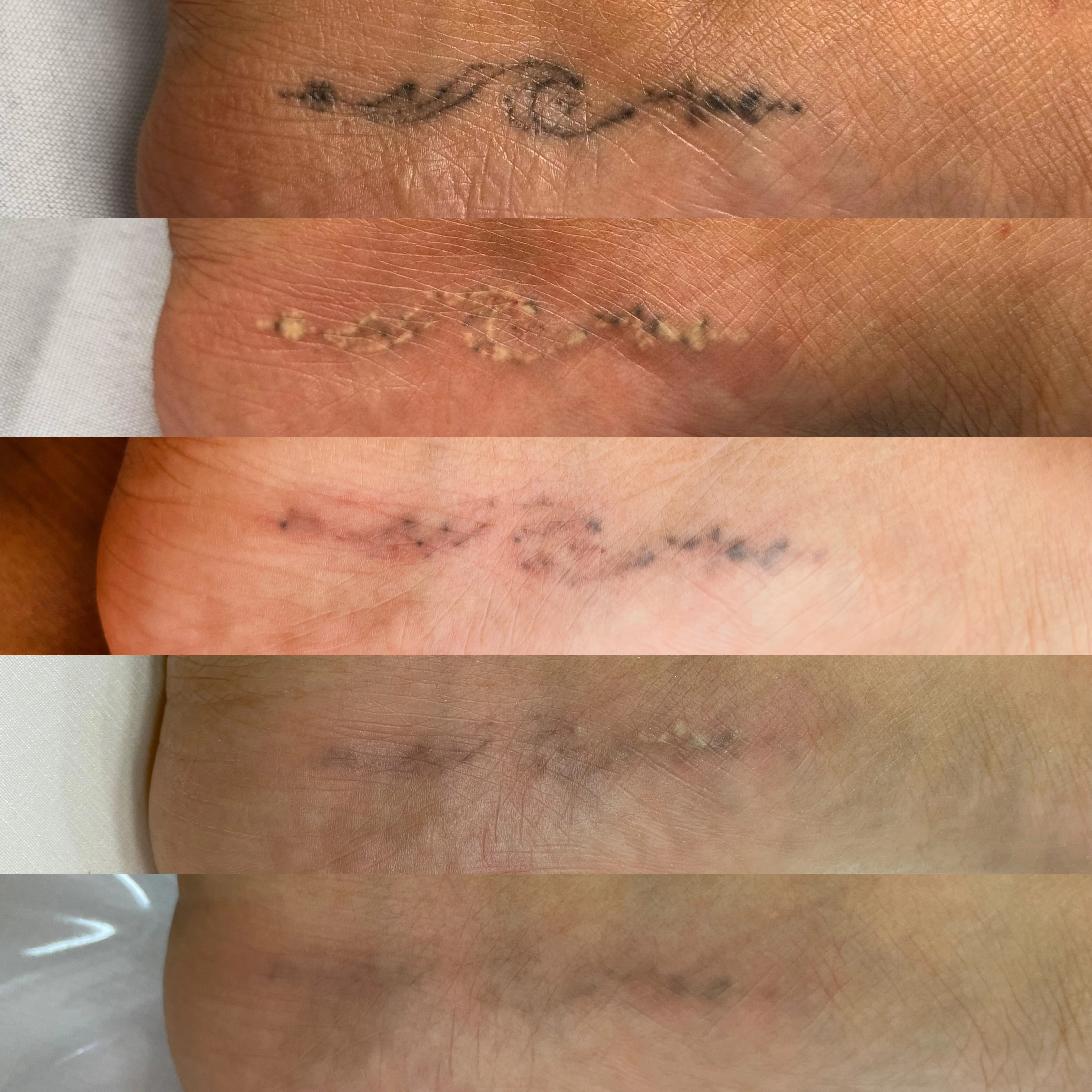Antes e depois de remoção a laser - Brenda Martins